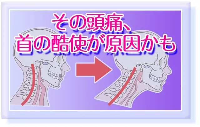 ブログタイトル「その頭痛、首の酷使が原因かも」