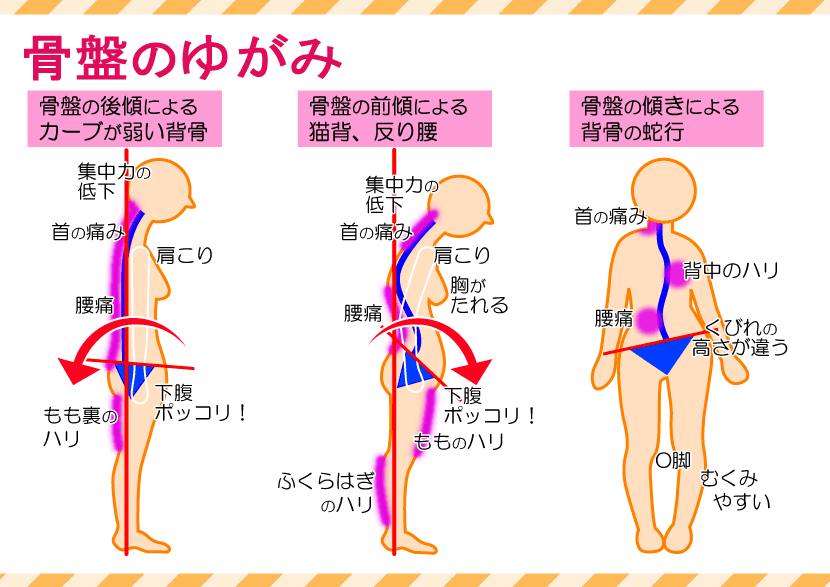 骨盤の歪み